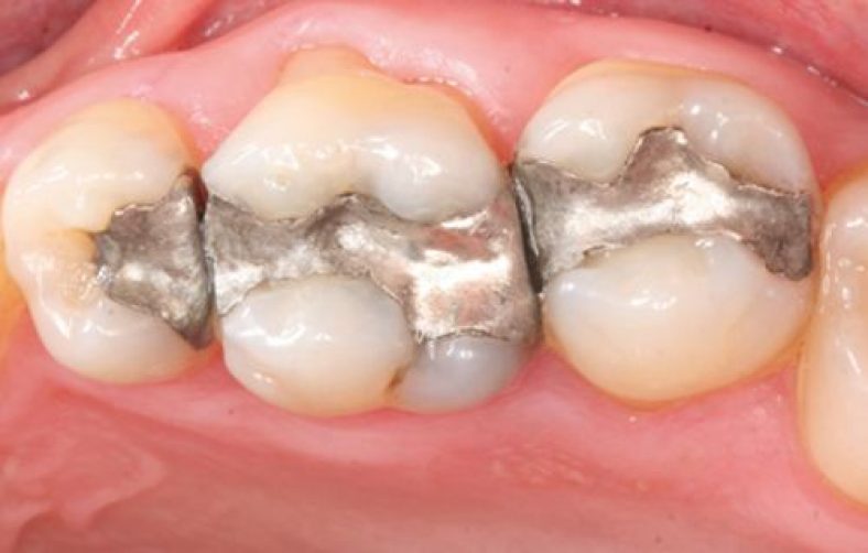 Dental amalgam Mafia continues to poison people Hot Party
