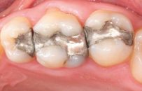 Dental amalgam: Mafia continues to poison people