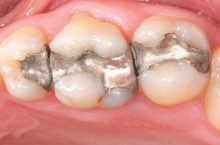 Dental amalgam: Mafia continues to poison people